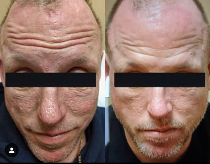 Before and after Bellafill acne scar correction — SNA Aesthetics Brooklyn
