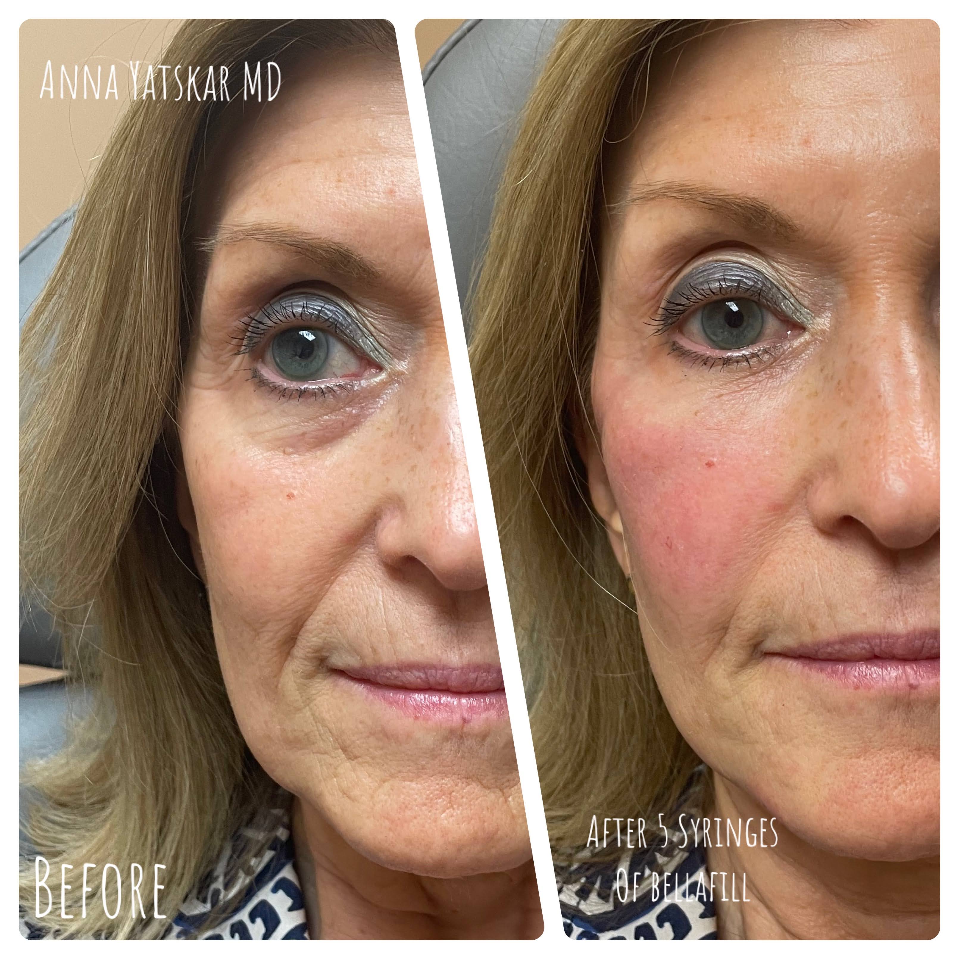 Before and after Bellafill treatment — SNA Aesthetics Brooklyn