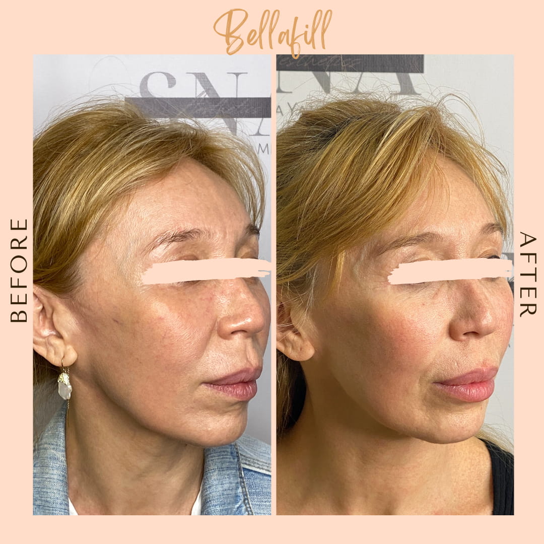 Before and after Bellafill full face — SNA Aesthetics Brooklyn