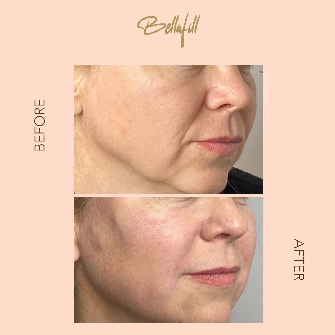 Before and after Bellafill jawline — SNA Aesthetics Brooklyn