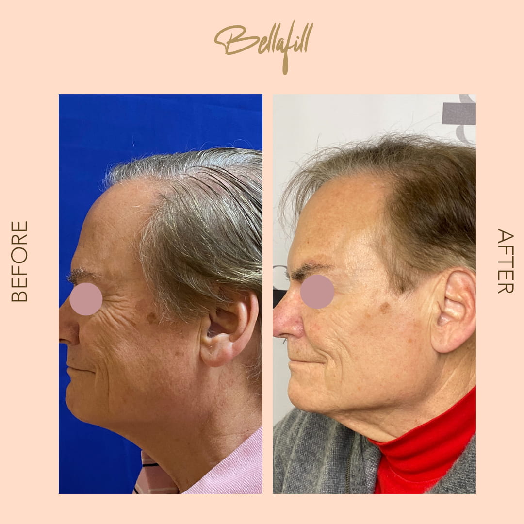 Before and after Bellafill profile — SNA Aesthetics Brooklyn