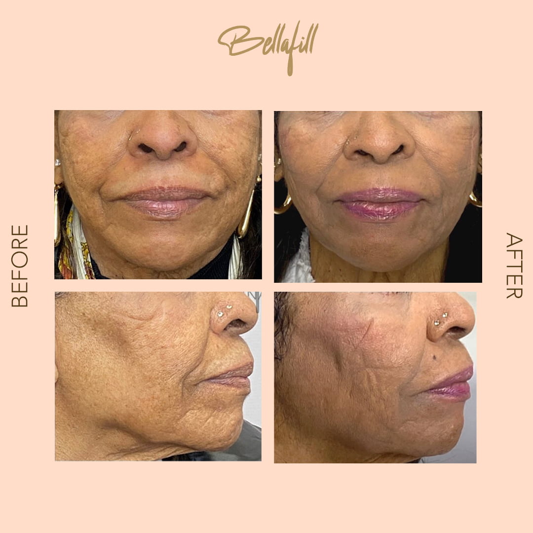 Before and after Bellafill lower face — SNA Aesthetics Brooklyn
