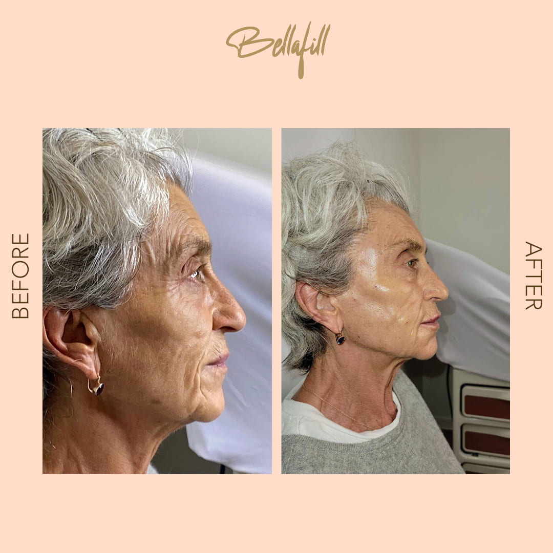 Before and after Bellafill profile restoration — SNA Aesthetics Brooklyn