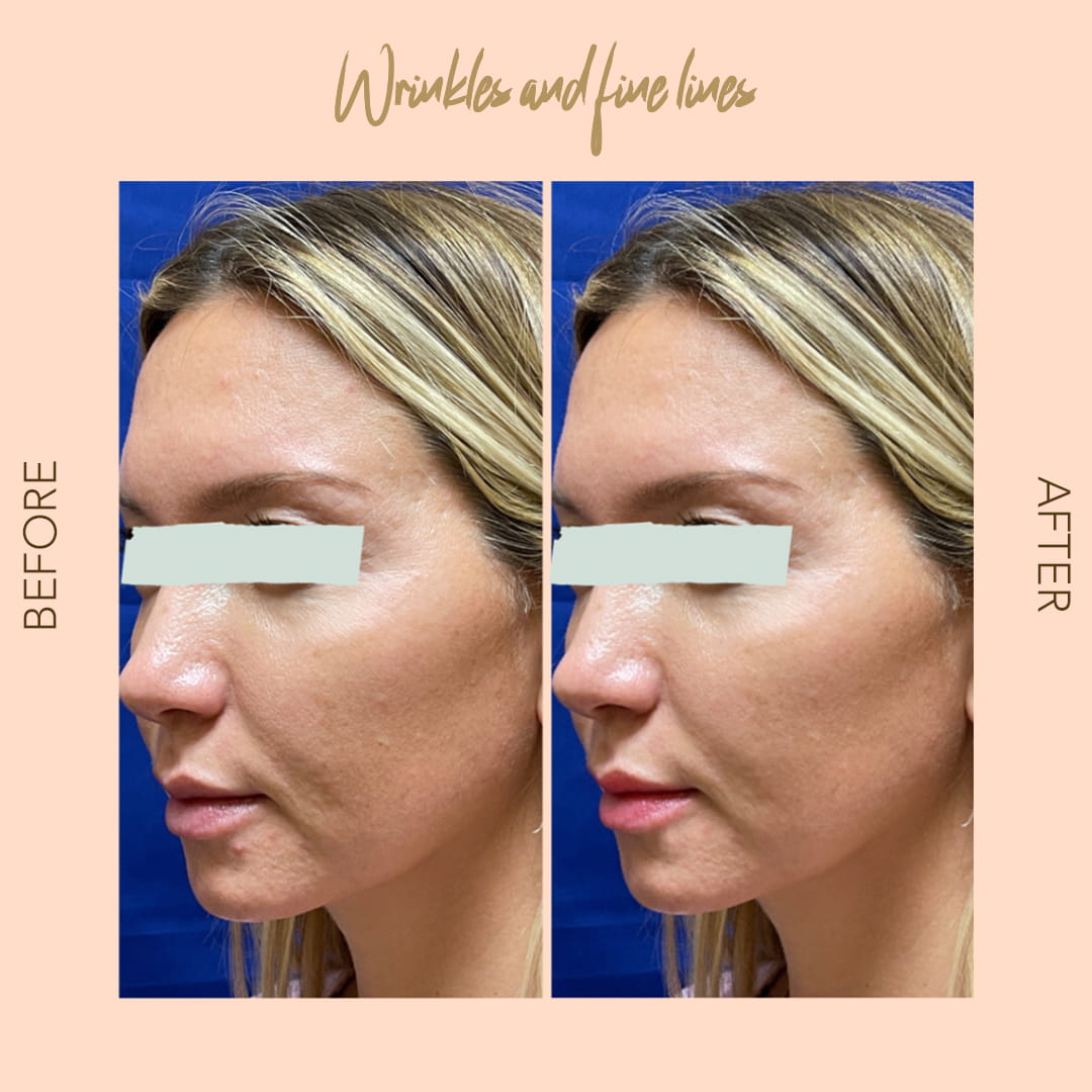 Before and after Botox fine lines — SNA Aesthetics Brooklyn