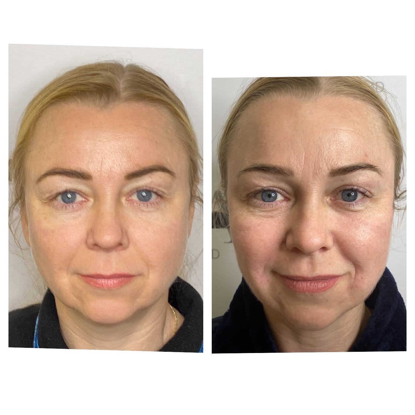 Before and after dermal fillers — SNA Aesthetics Brooklyn
