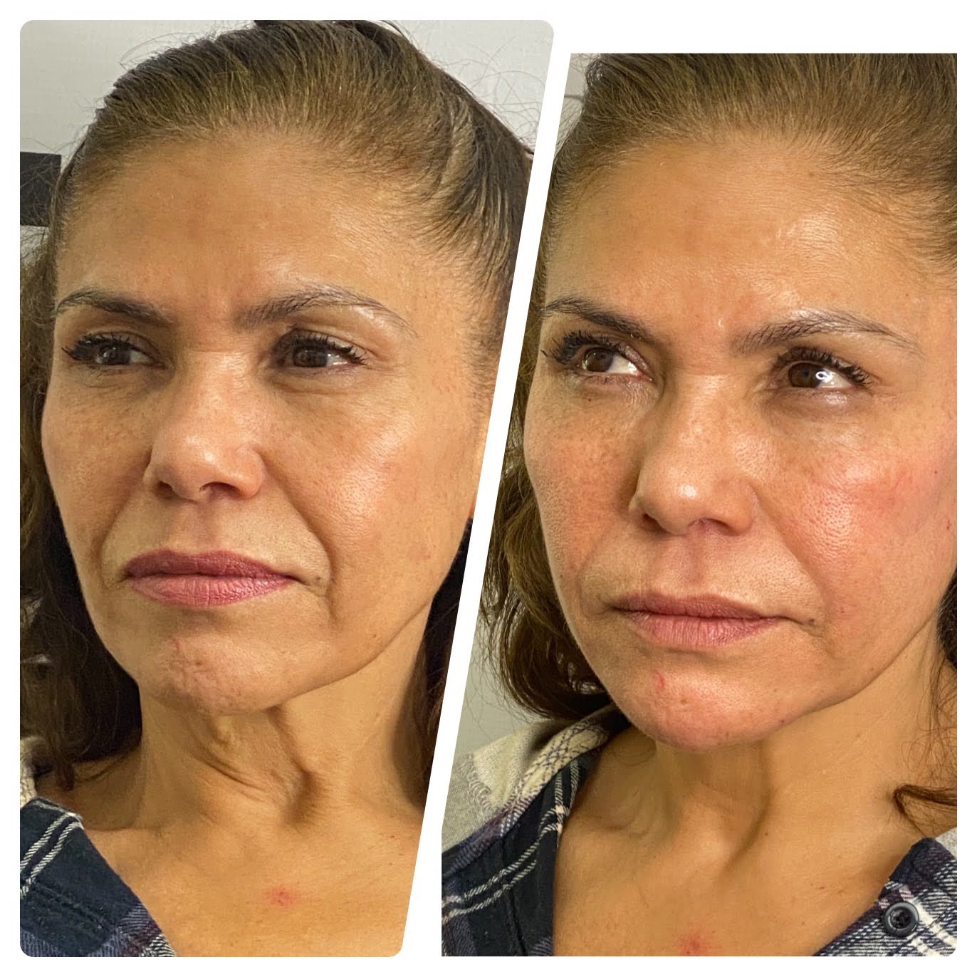 Before and after full face rejuvenation — SNA Aesthetics Brooklyn