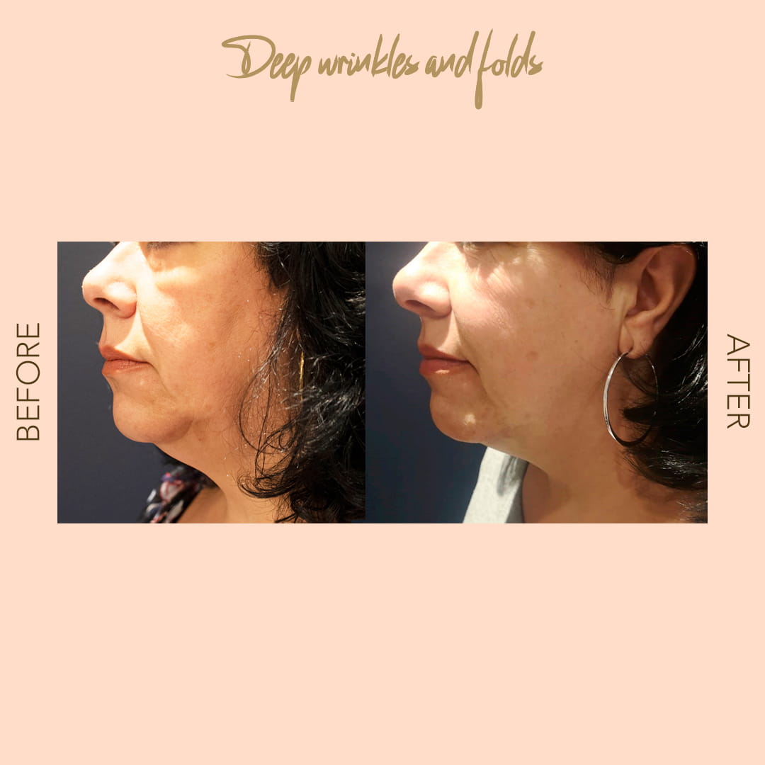 Before and after Forma RF deep wrinkles — SNA Aesthetics Brooklyn