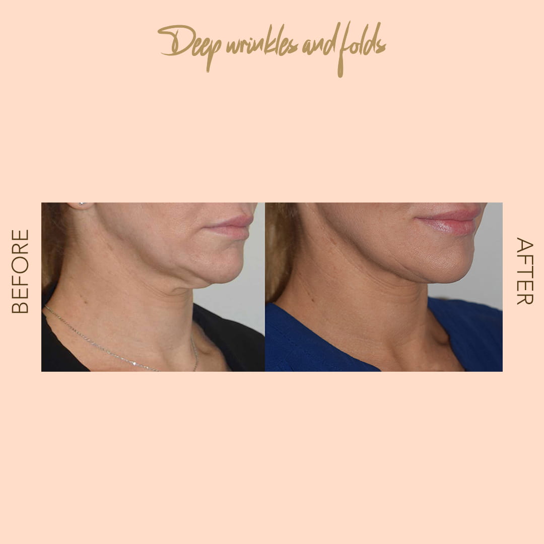Before and after Forma RF neck tightening — SNA Aesthetics Brooklyn