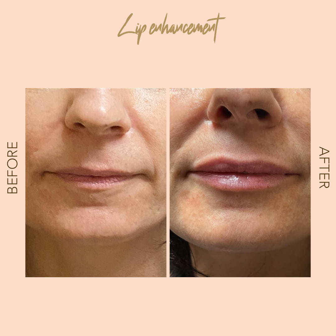 Before and after lip enhancement — SNA Aesthetics Brooklyn