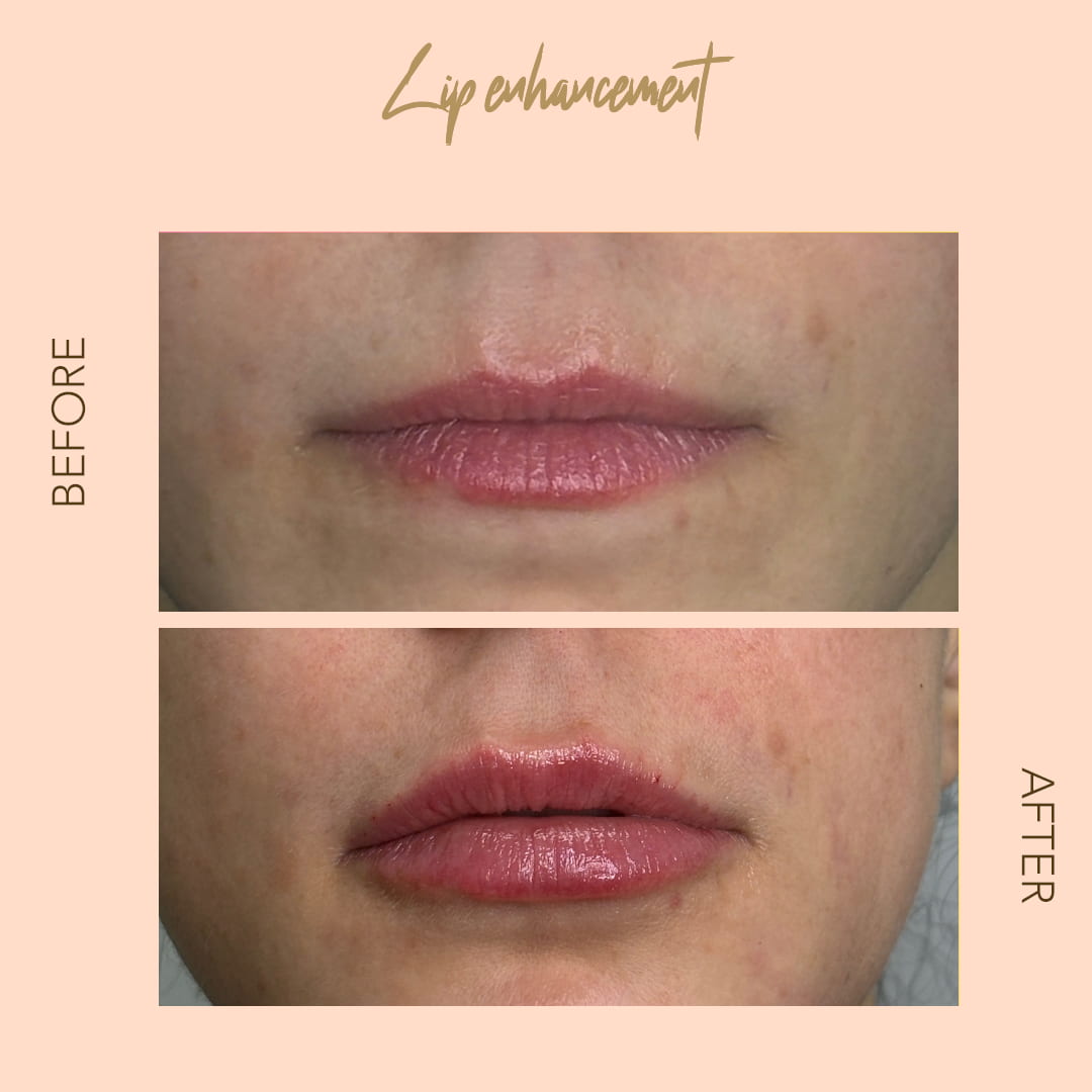 Before and after lip enhancement — SNA Aesthetics Brooklyn