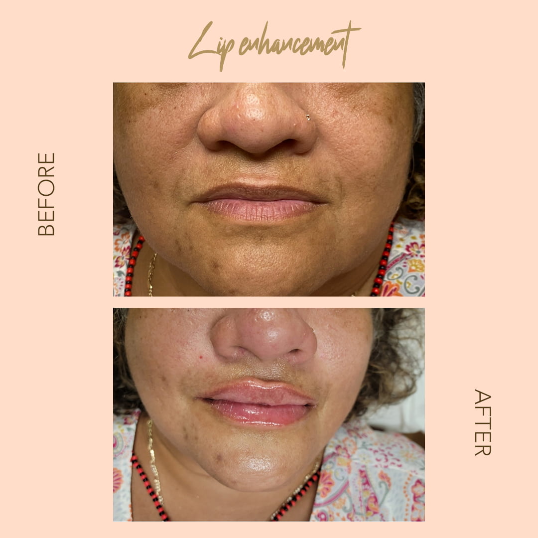 Before and after lip enhancement — SNA Aesthetics Brooklyn