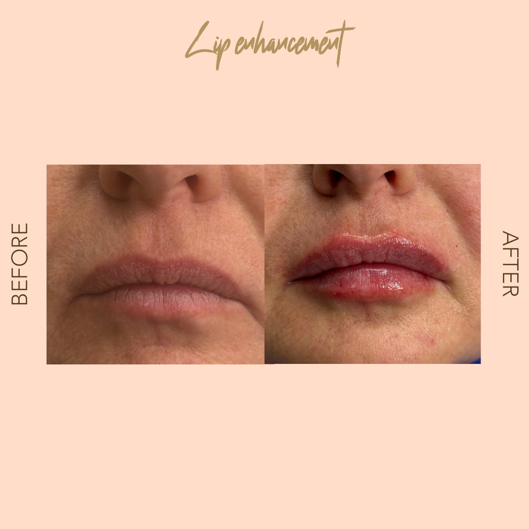 Before and after lip enhancement — SNA Aesthetics Brooklyn