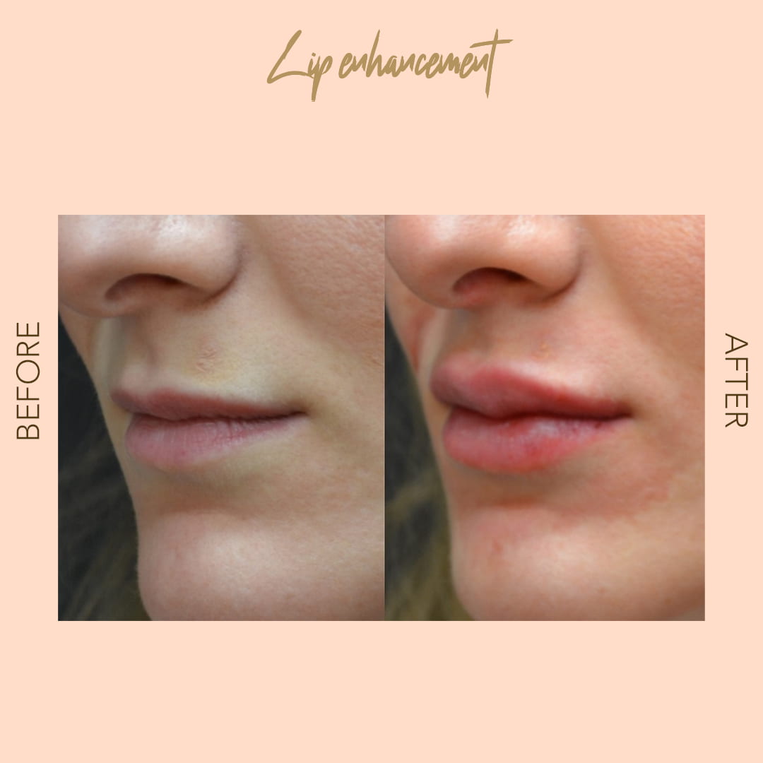Before and after lip enhancement — SNA Aesthetics Brooklyn
