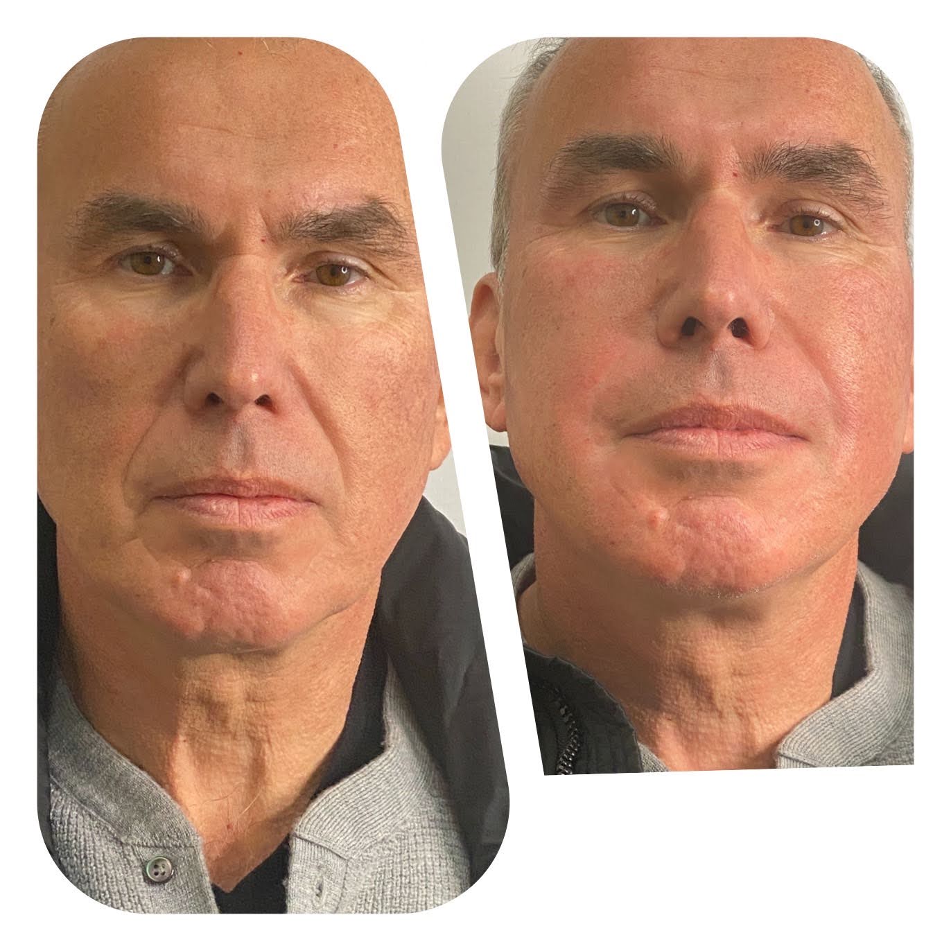 Before and after full face rejuvenation — Male patient — SNA Aesthetics Brooklyn