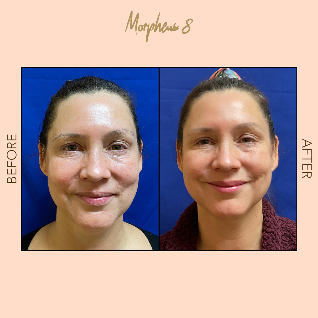 Before and after Morpheus8 full face — SNA Aesthetics Brooklyn
