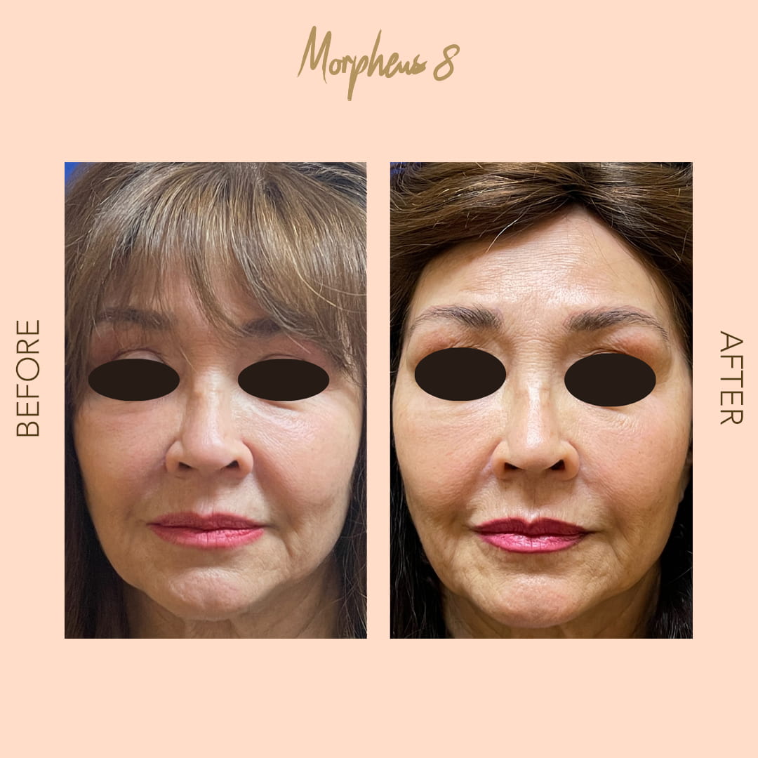 Before and after Morpheus8 full face — SNA Aesthetics Brooklyn