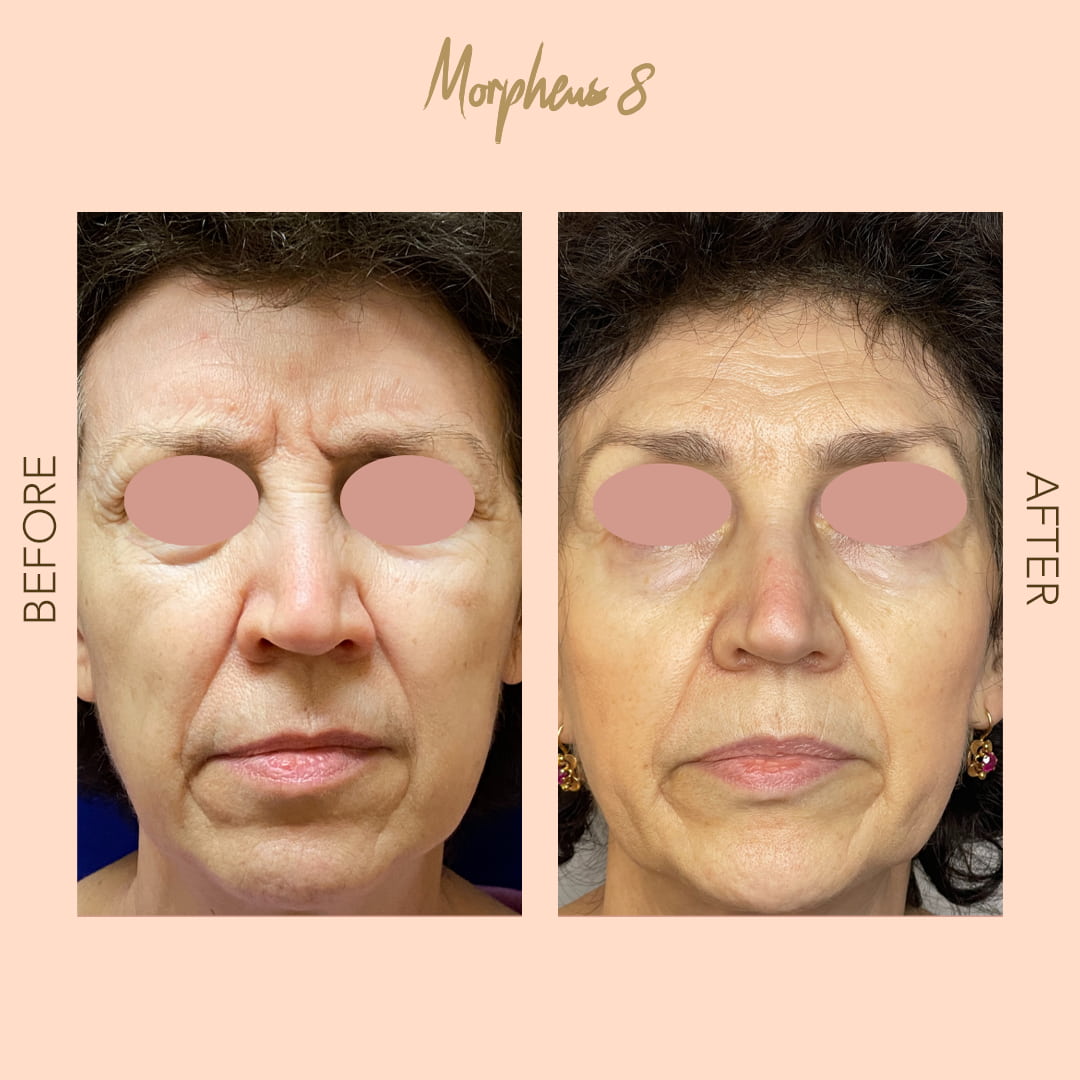 Before and after Morpheus8 deep wrinkle reduction — SNA Aesthetics Brooklyn