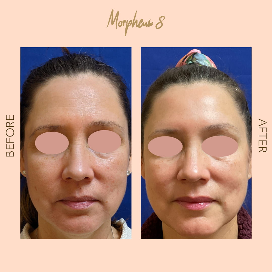 Before and after Morpheus8 skin tightening — SNA Aesthetics Brooklyn