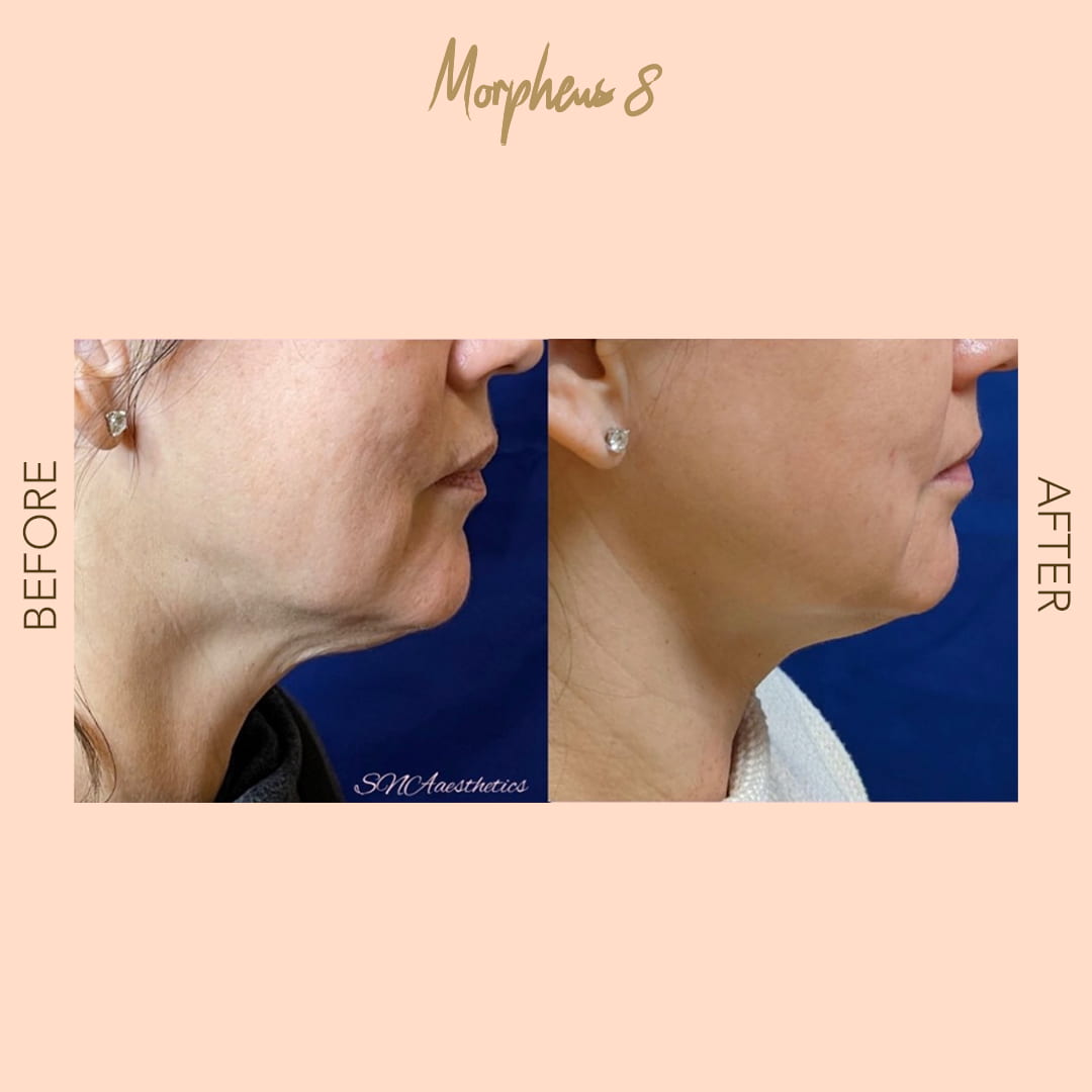 Before and after Morpheus8 jawline — SNA Aesthetics Brooklyn