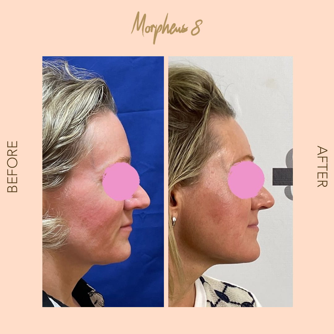 Before and after Morpheus8 profile — SNA Aesthetics Brooklyn