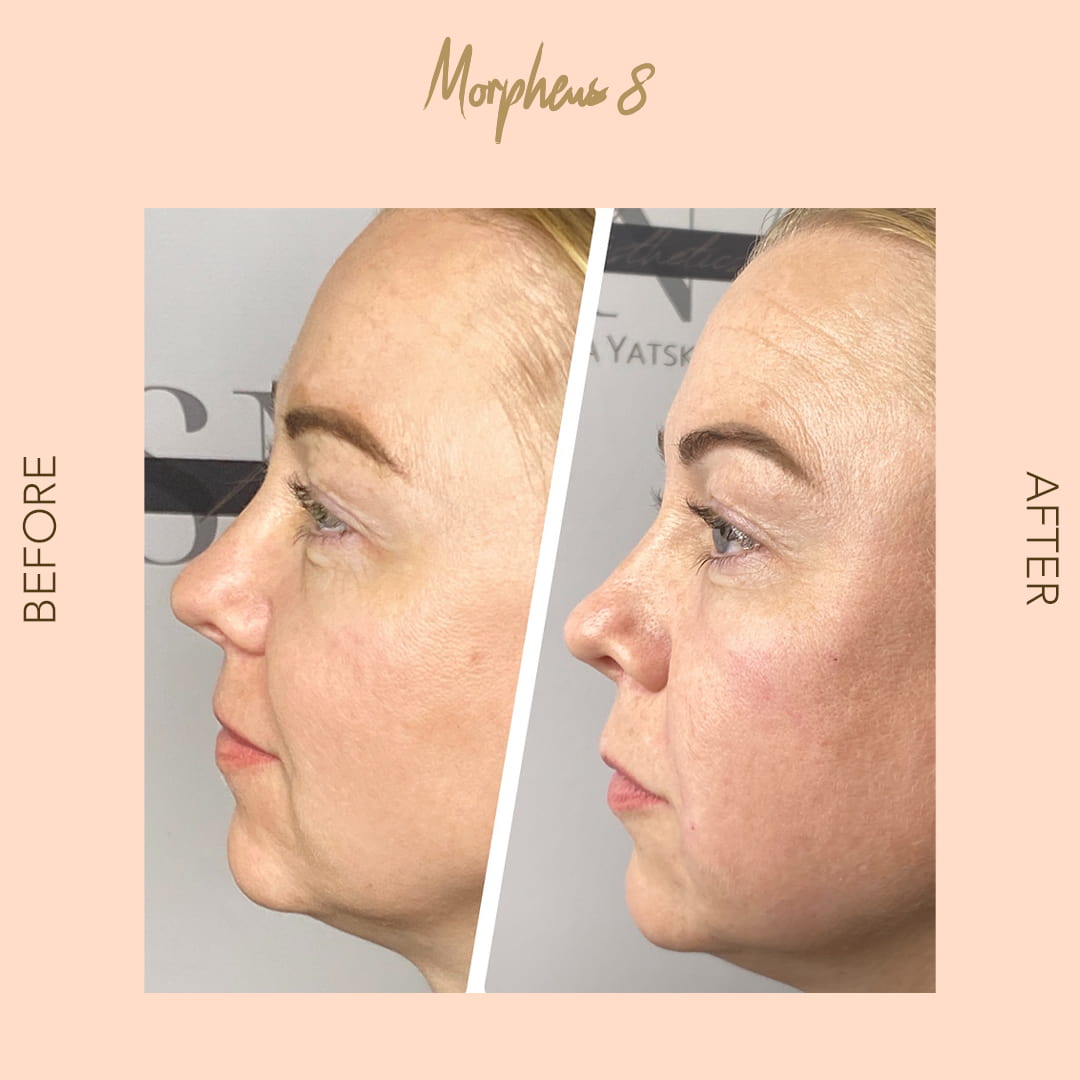 Before and after Morpheus8 profile — SNA Aesthetics Brooklyn