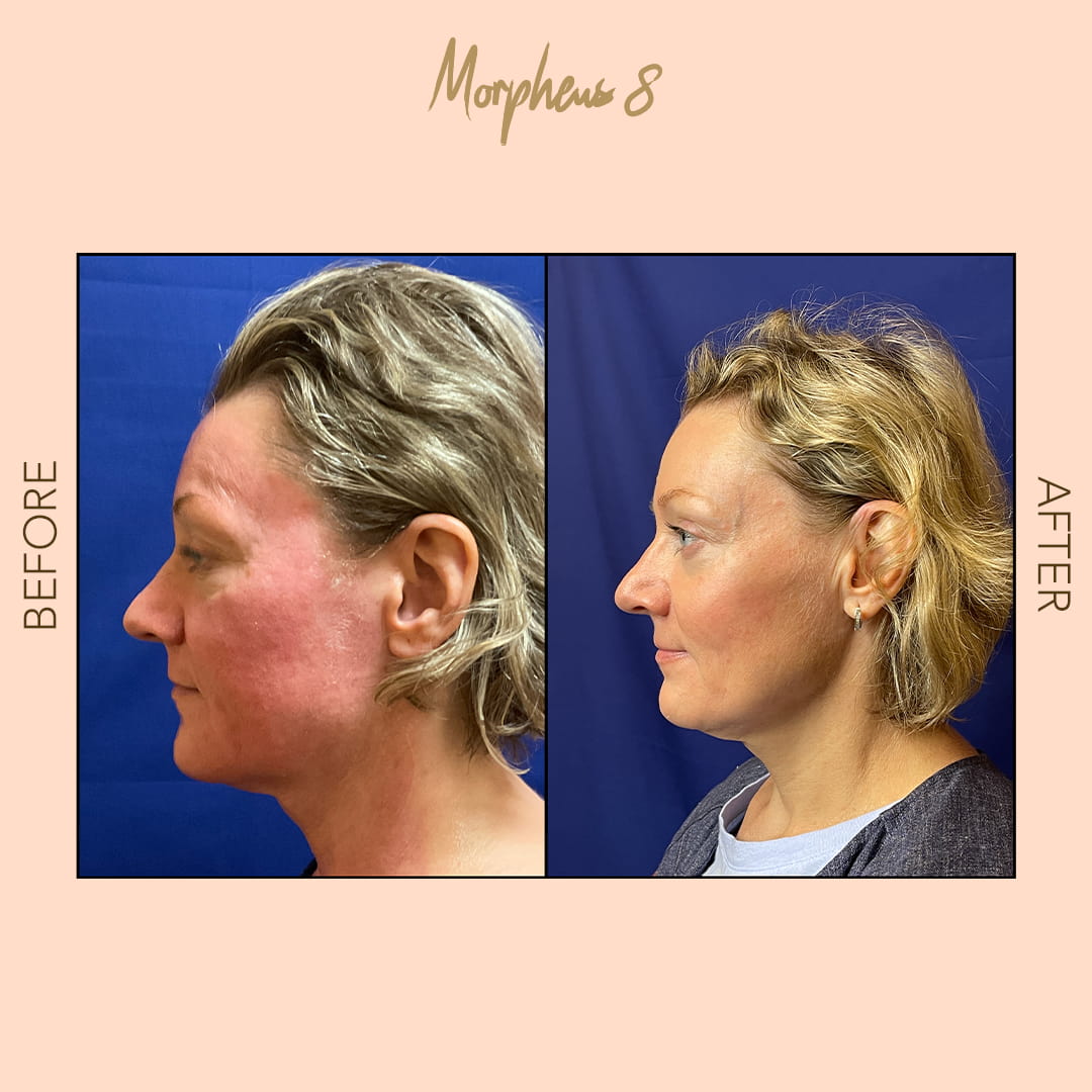 Before and after Morpheus8 profile tightening — SNA Aesthetics Brooklyn