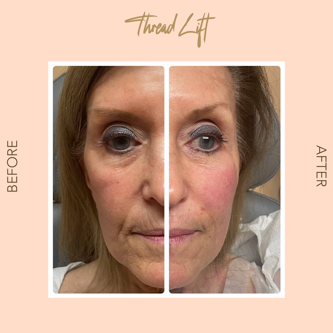 Before and after thread lift — SNA Aesthetics Brooklyn
