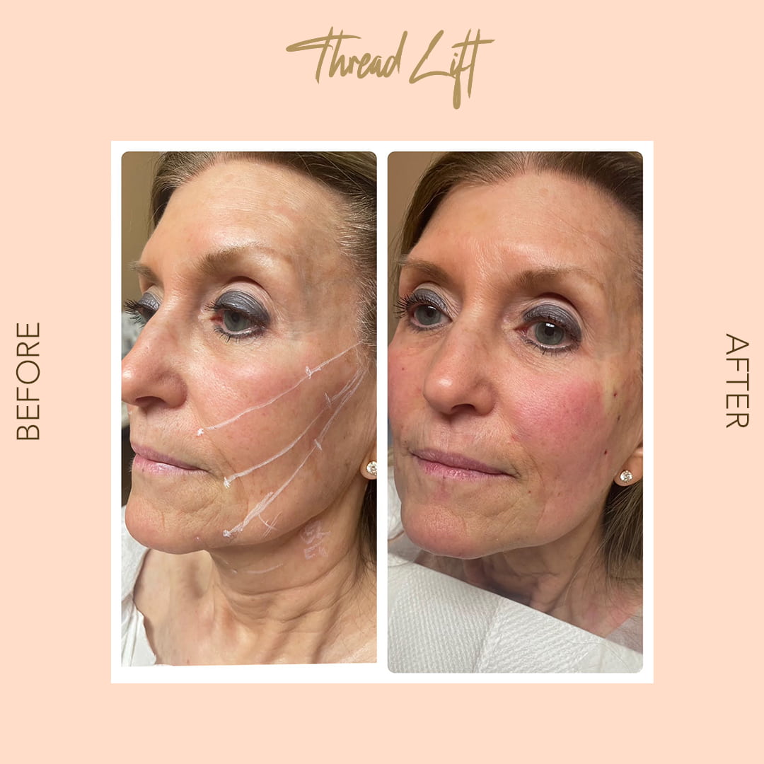 Before and after thread lift jowl lift — SNA Aesthetics Brooklyn