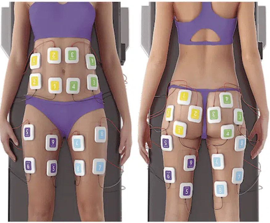 truSculpt flex muscle building treatment Brooklyn — SNA Aesthetics Dr. Anna Yatskar